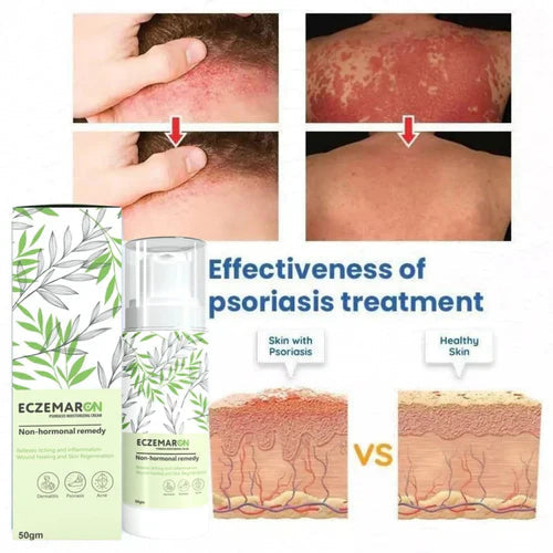 Fungal out Anti - Fungal Spray (Buy 1 Get1 Free)