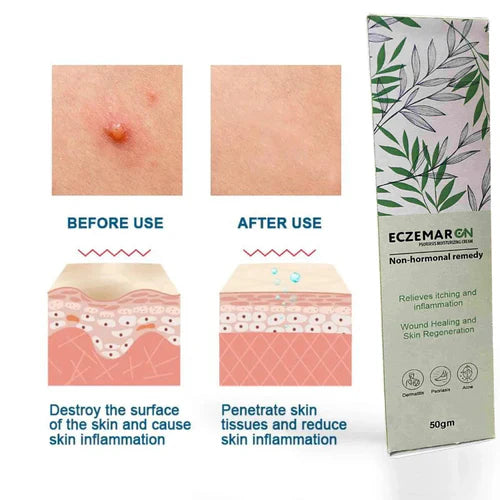 Fungal out Anti - Fungal Spray (Buy 1 Get1 Free)
